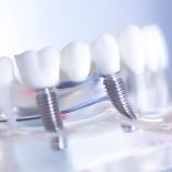 Multiple Implants