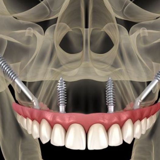Zygomatic Implants