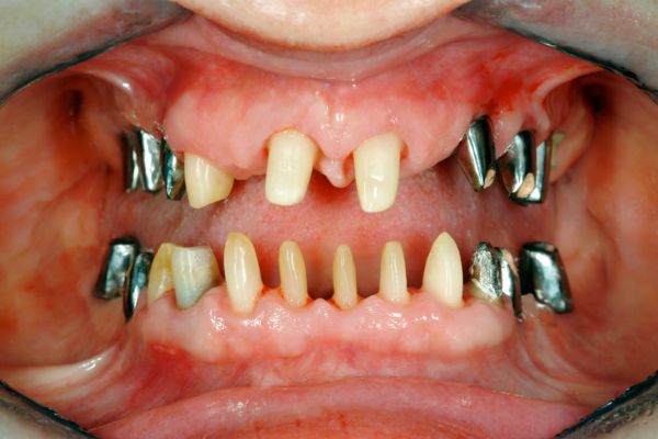 Full Mouth Reconstruction