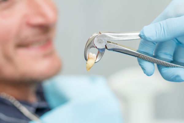 Tooth Extractions Irving TX