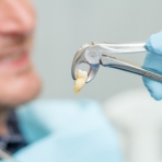 Tooth Extraction